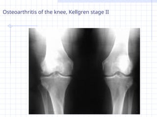 OSTEOARTHRITIS in depth review in orthopaedic .ppt