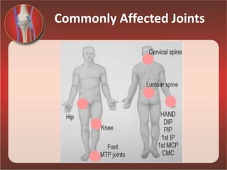 Commonly Affected Joints
 