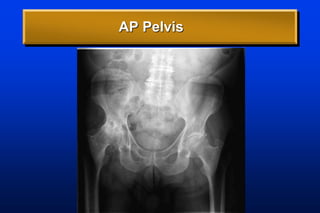AP Pelvis
 