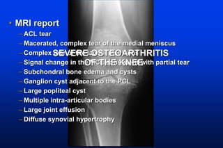 • MRI report
– ACL tear
– Macerated, complex tear of the medial meniscus
– Complex tear of the lateral meniscus
– Signal change in the MCL consistent with partial tear
– Subchondral bone edema and cysts
– Ganglion cyst adjacent to the PCL
– Large popliteal cyst
– Multiple intra-articular bodies
– Large joint effusion
– Diffuse synovial hypertrophy
SEVERE OSTEOARTHRITIS
OF THE KNEE
 