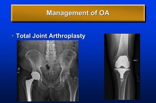 Management of OA
• Total Joint Arthroplasty
 