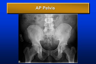 AP Pelvis
 