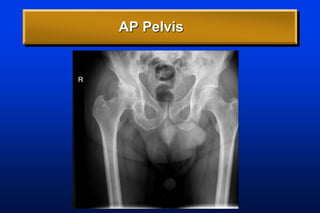 AP Pelvis
 