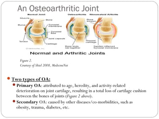 An Osteoarthritic Joint




      Figure 2.
      Courtesy of Shiel 2008, MedicineNet


 Two types of OA:
  Primary OA: attributed to age, heredity, and activity-related
   deterioration on joint cartilage, resulting in a total loss of cartilage cushion
   between the bones of joints (Figure 2 above).
  Secondary OA: caused by other diseases/co-morbidities, such as
   obesity, trauma, diabetes, etc.
 