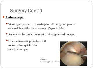 Surgery Cont’d
Arthroscopy

 Viewing scope inserted into the joint, allowing a surgeon to
   view and detect the site of damage (Figure 5, below)
 Sometimes this can be can repaired through an arthroscope.

 Often a successful procedure with
   recovery time quicker than
   open joint surgery.


                                Figure 5.
                                Courtesy of Essex Knee Surgery
 
