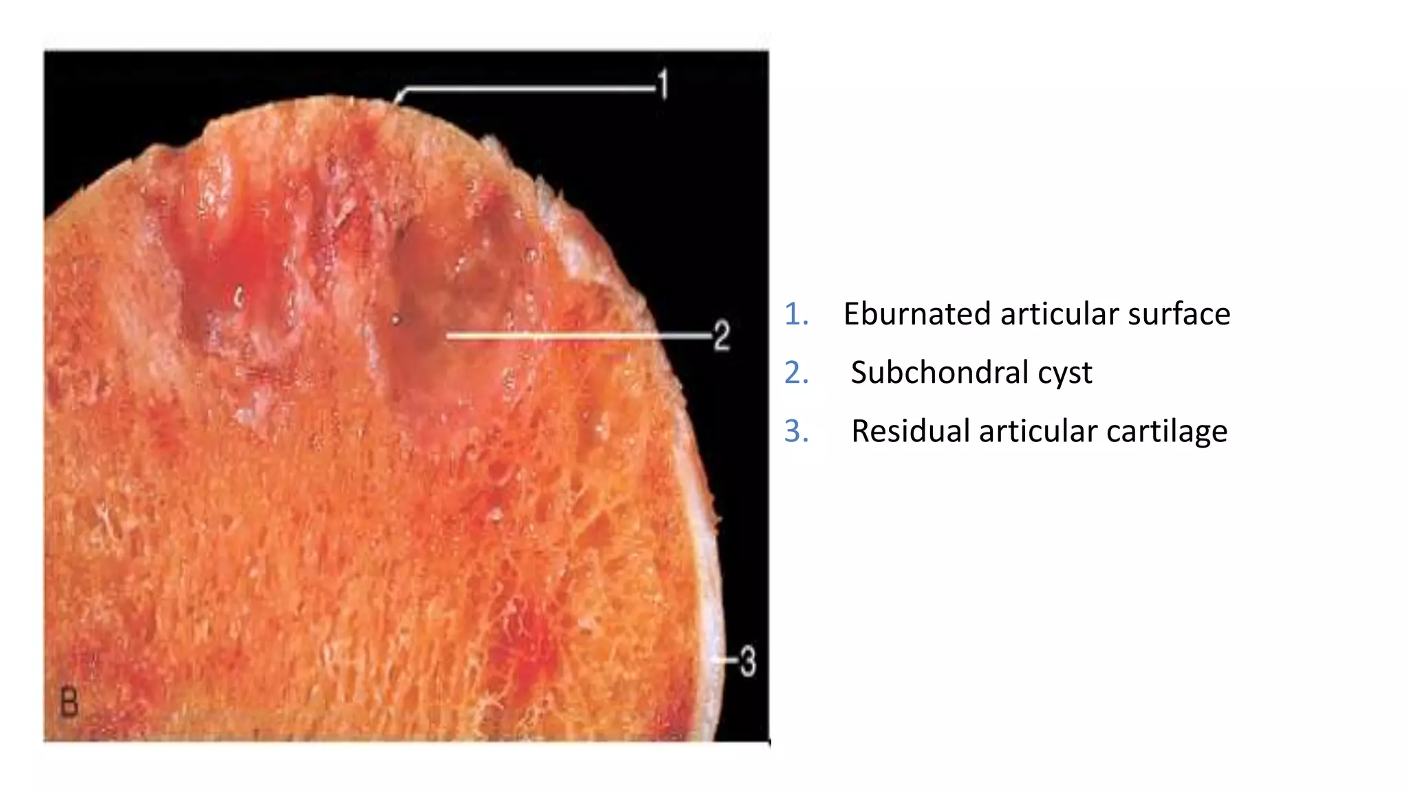 1. Eburnated articular surface
2. Subchondral cyst
3. Residual articular cartilage
 