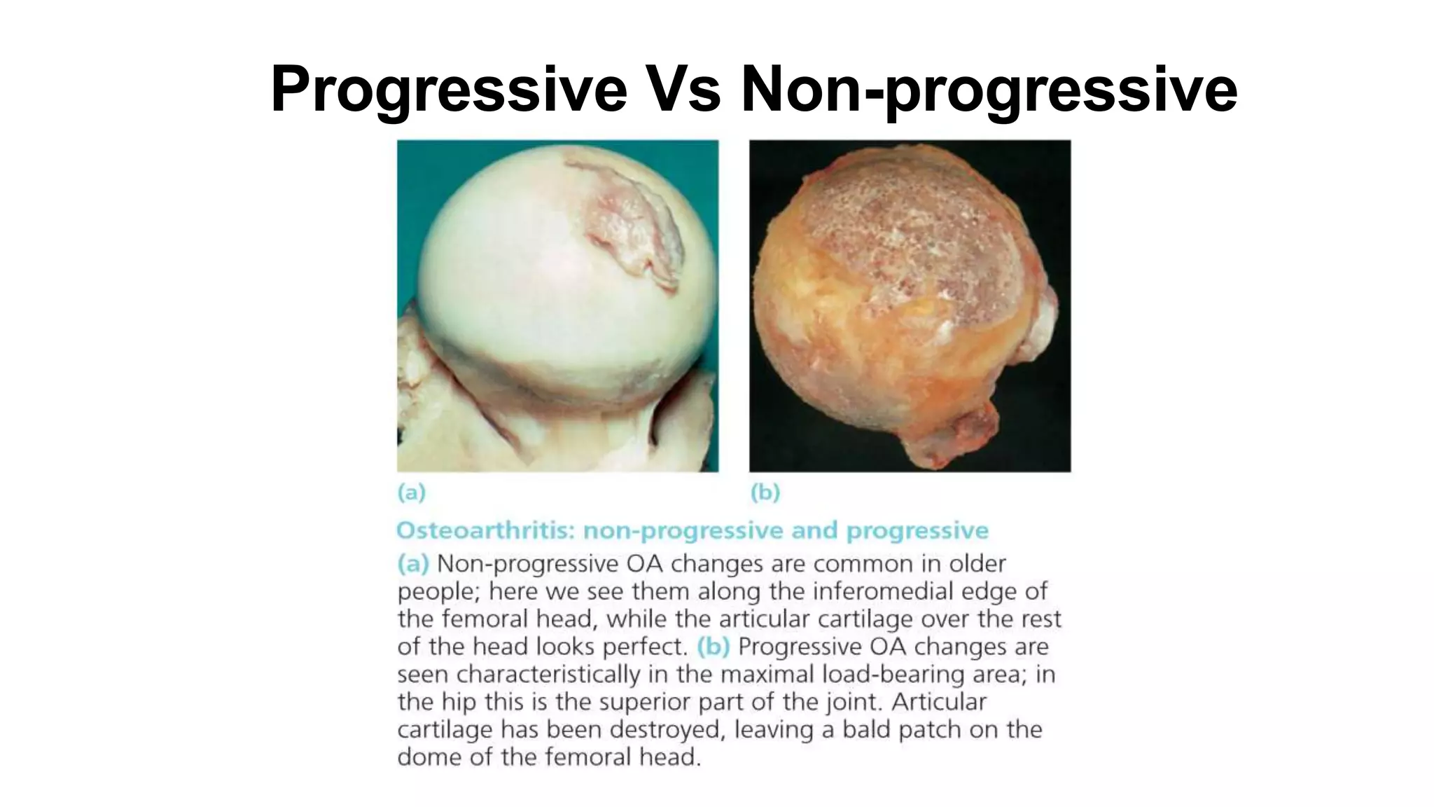 Progressive Vs Non-progressive
 