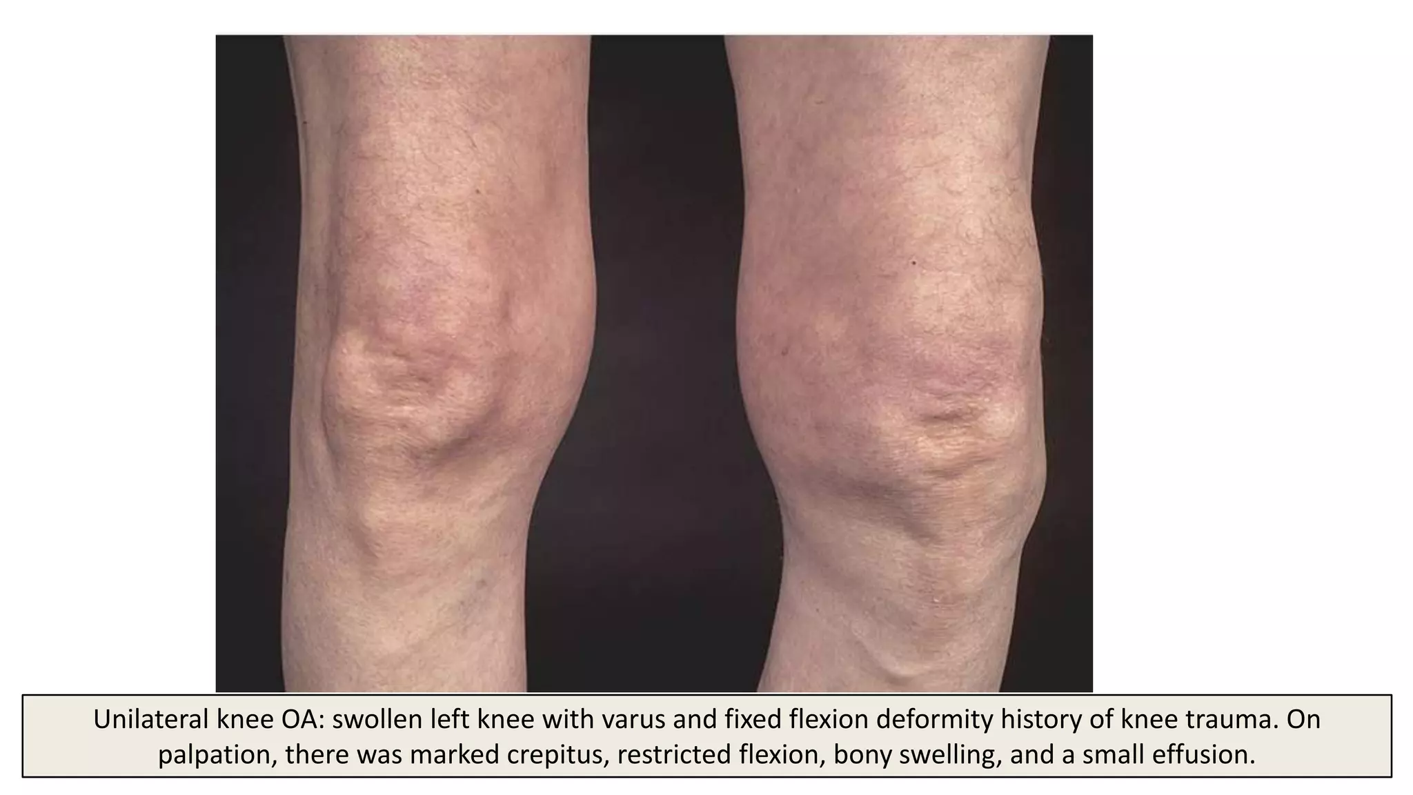 31
Unilateral knee OA: swollen left knee with varus and fixed flexion deformity history of knee trauma. On
palpation, there was marked crepitus, restricted flexion, bony swelling, and a small effusion.
 