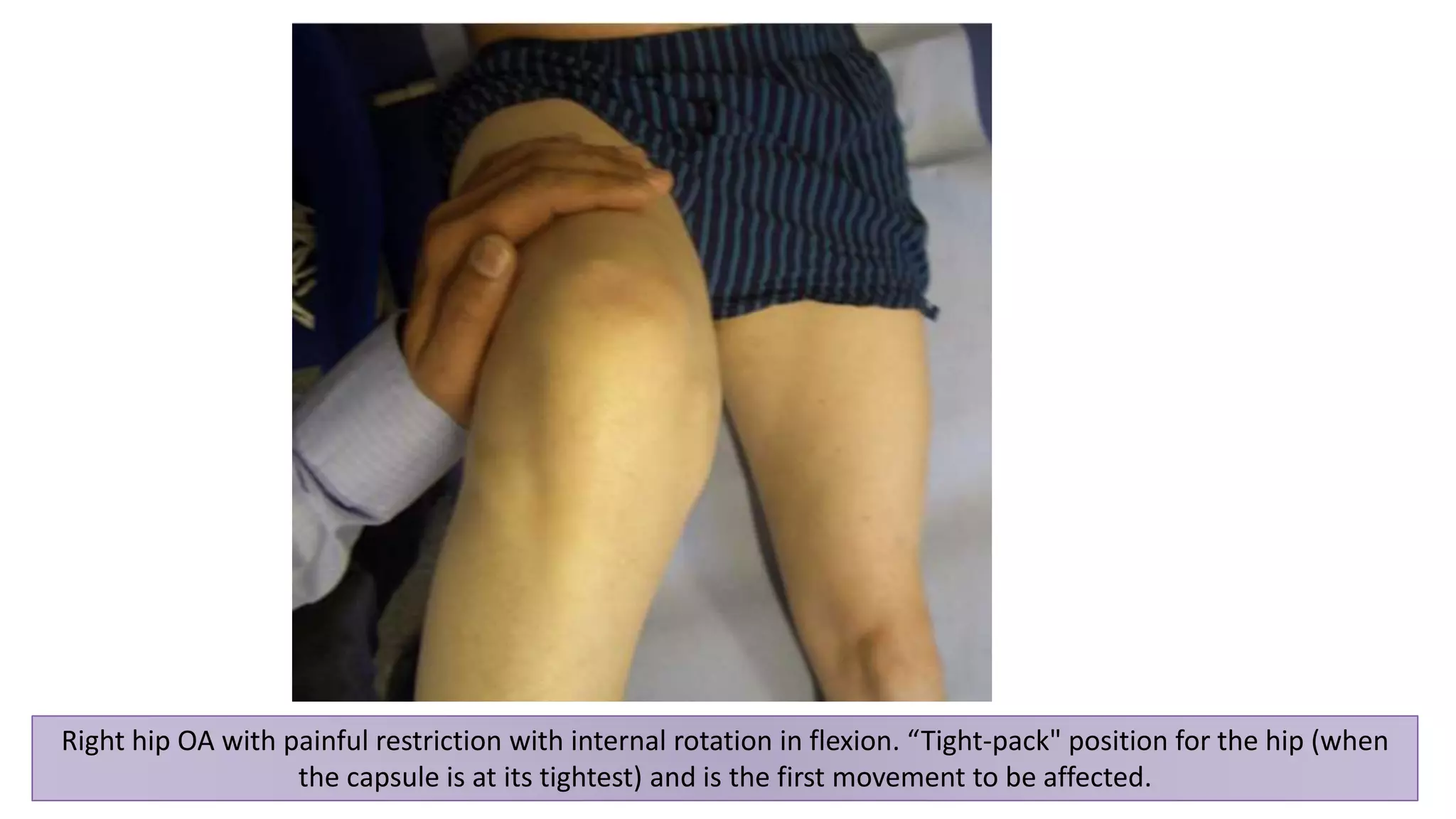 32
Right hip OA with painful restriction with internal rotation in flexion. “Tight-pack" position for the hip (when
the capsule is at its tightest) and is the first movement to be affected.
 