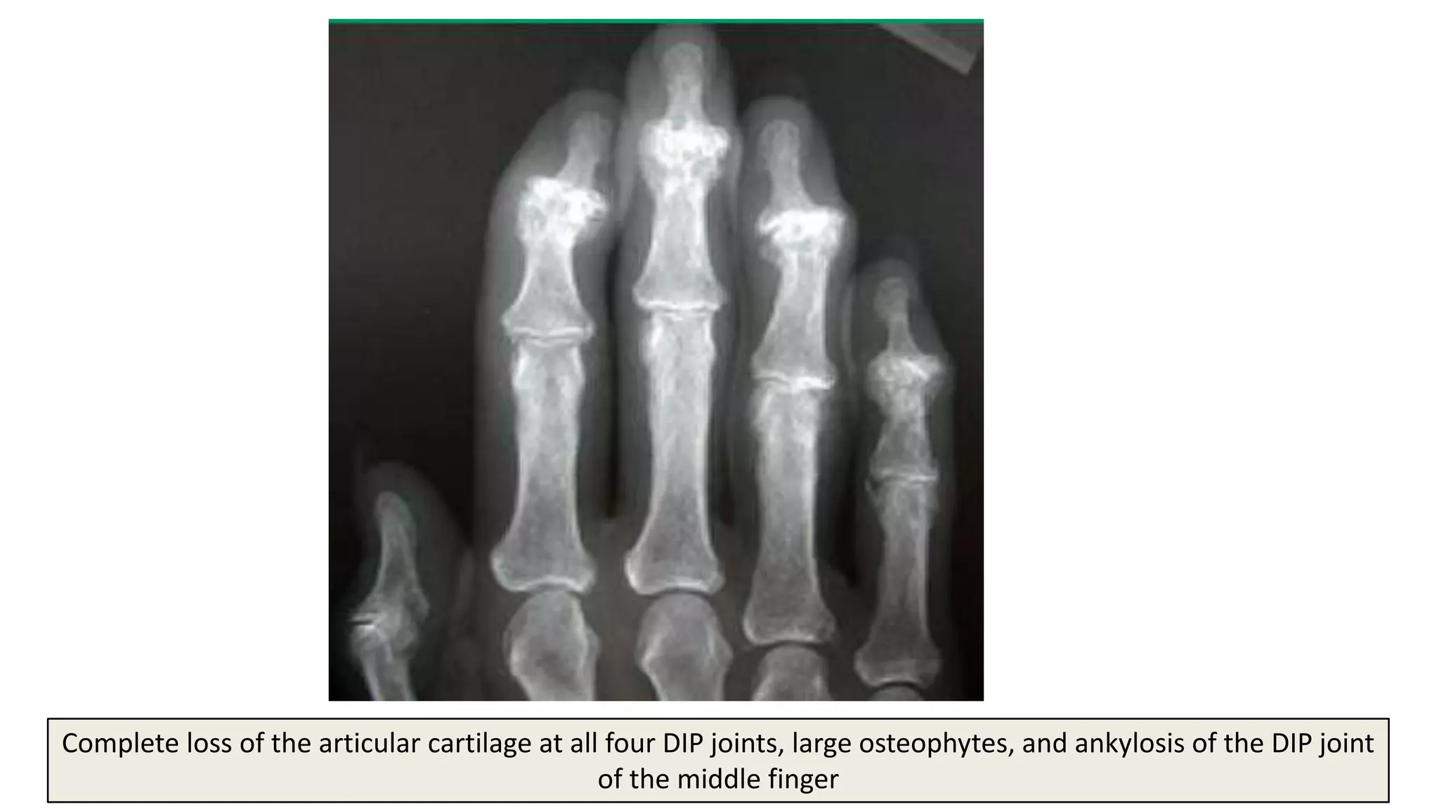 38
Complete loss of the articular cartilage at all four DIP joints, large osteophytes, and ankylosis of the DIP joint
of the middle finger
 