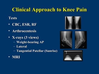 Clinical Approach to Knee Pain
Tests
• CBC, ESR, RF
• Arthrocentesis
• X-rays (3 views)
  – Weight-bearing AP
  – Lateral
  – Tangential Patellar (Sunrise)
• MRI
 