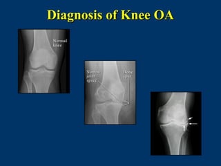 Diagnosis of Knee OA
 