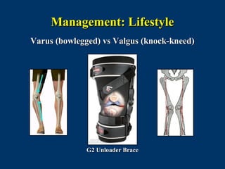 Management: Lifestyle
Varus (bowlegged) vs Valgus (knock-kneed)




             G2 Unloader Brace
 