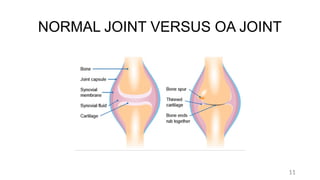 OSTEOARTHRITIS ,an inflammation of the joints ,knee | PPTX
