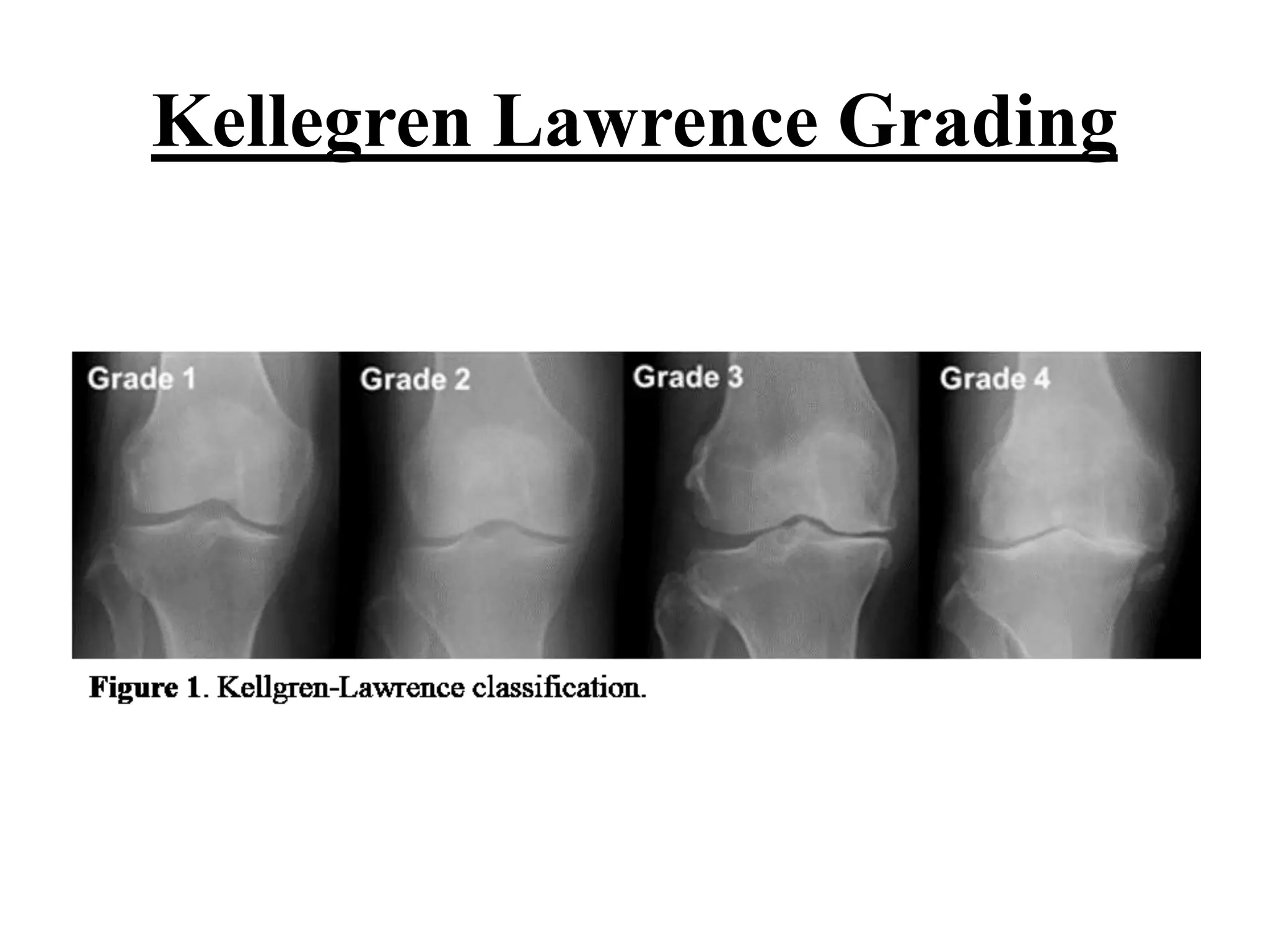 Knee Classification Osteoarthritis knee | PPTX