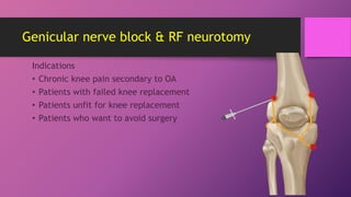 Osteoarthritis knee,, pain management | PPTX