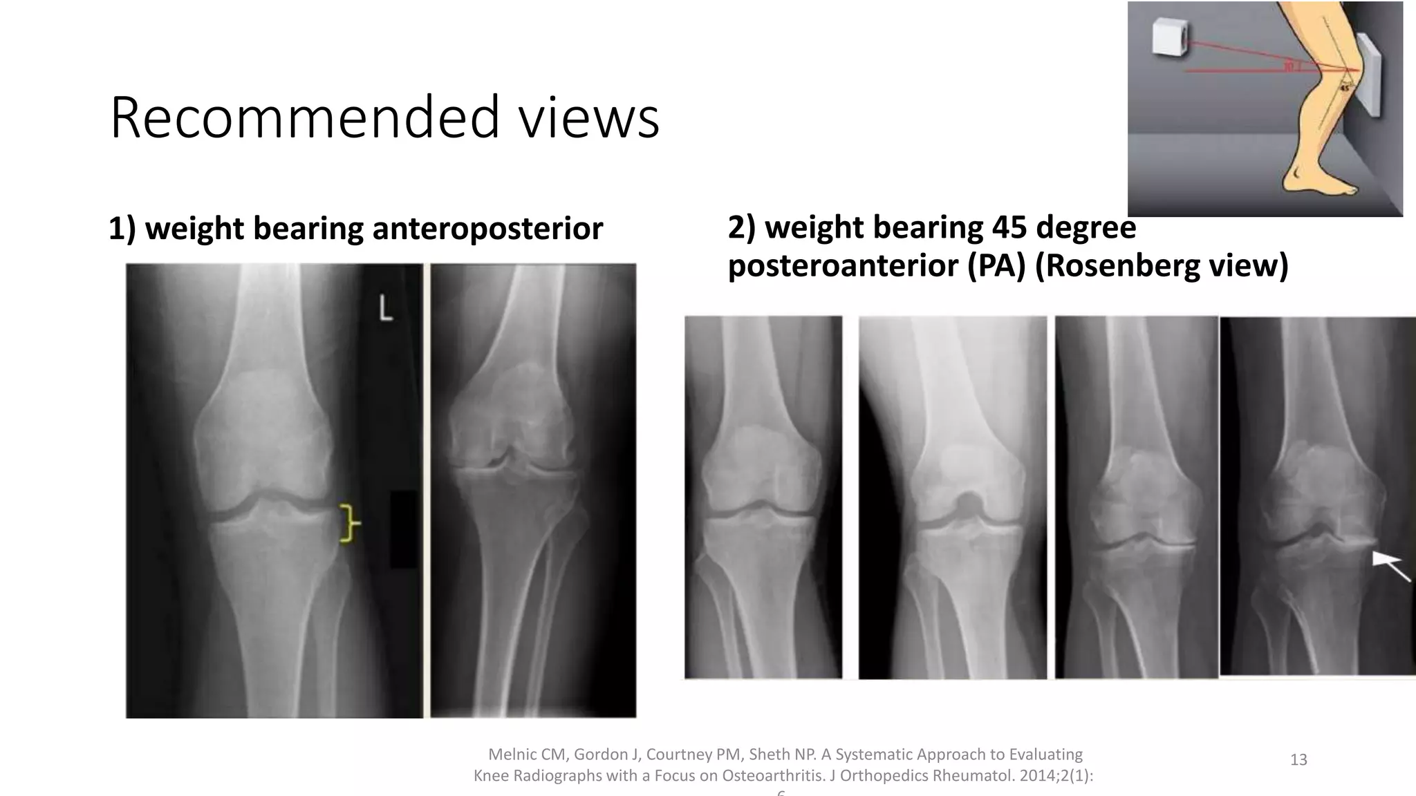 Osteoarthritis – Knee | PPTX
