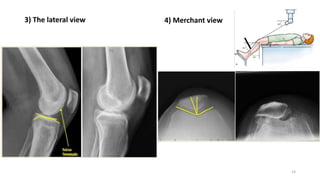 Merchat View Osteoarthritis – Knee | PPTX