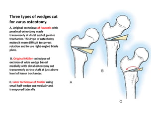 Varus Rotation Osteotomy Osteoarthritis of hip in orthoapedics.pptx