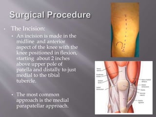 Osteoarthritis of Knee Joint | PPTX