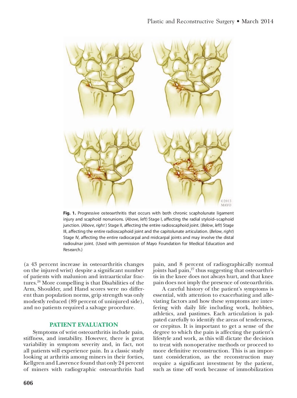 Osteoarthritis of the_wrist from Mayo Clinic