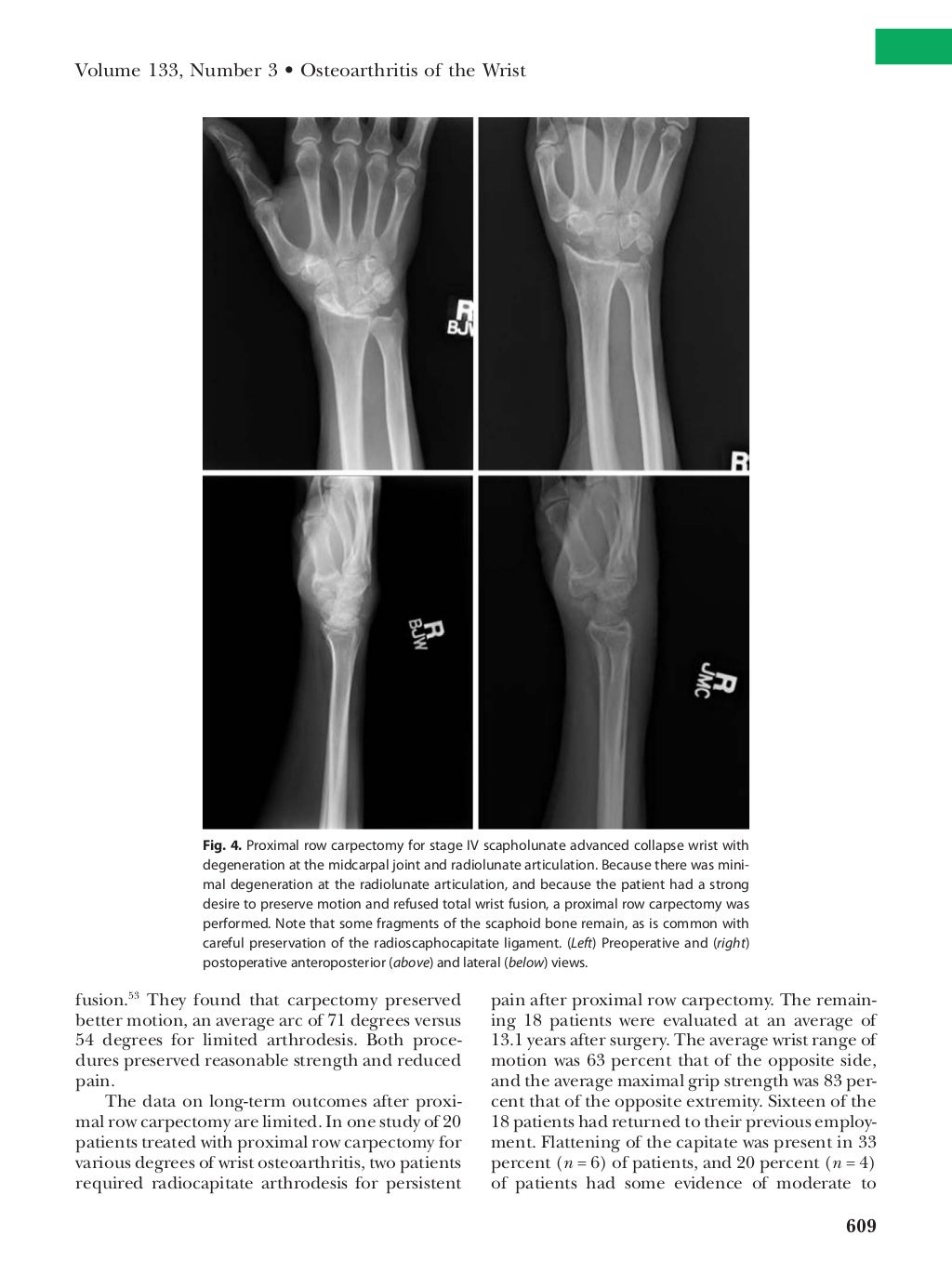 Osteoarthritis of the_wrist from Mayo Clinic