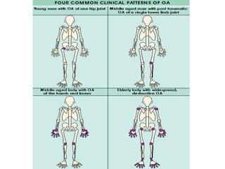 Osteoarthritis Diagnosis and management | PPT