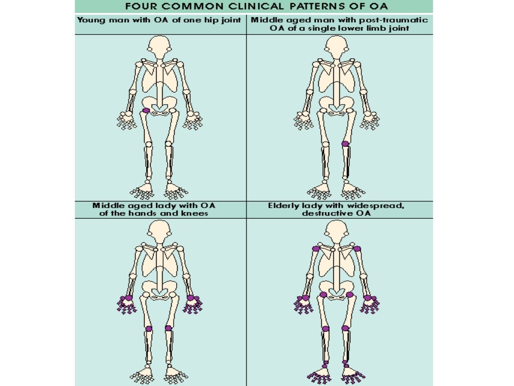 Osteoarthritis Diagnosis and management