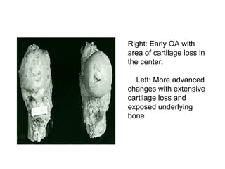 Right: Early OA with
area of cartilage loss in
the center.

  Left: More advanced
changes with extensive
cartilage loss and
exposed underlying
bone
 