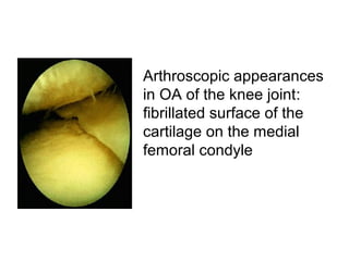 Arthroscopic appearances
in OA of the knee joint:
fibrillated surface of the
cartilage on the medial
femoral condyle
 
