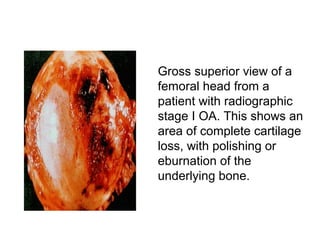 Gross superior view of a
femoral head from a
patient with radiographic
stage I OA. This shows an
area of complete cartilage
loss, with polishing or
eburnation of the
underlying bone.
 