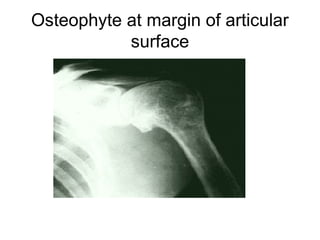 Osteophyte at margin of articular
           surface
 