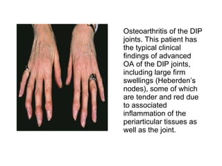 Osteoarthritis of the DIP
joints. This patient has
the typical clinical
findings of advanced
OA of the DIP joints,
including large firm
swellings (Heberden’s
nodes), some of which
are tender and red due
to associated
inflammation of the
periarticular tissues as
well as the joint.
 