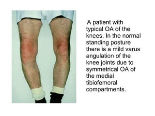 A patient with
typical OA of the
knees. In the normal
standing posture
there is a mild varus
angulation of the
knee joints due to
symmetrical OA of
the medial
tibiofemoral
compartments.
 
