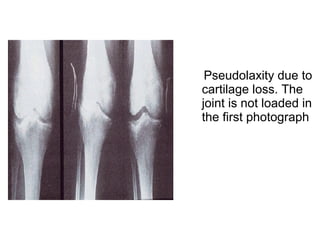 Pseudolaxity due to
cartilage loss. The
joint is not loaded in
the first photograph
 
