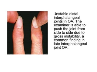 Unstable distal
interphalangeal
joints in OA. The
examiner is able to
push the joint from
side to side due to
gross instability, a
common finding in
late interphalangeal
joint OA.
 