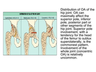 Distribution of OA of the
hip joint. OA can
maximally affect the
superior pole, inferior
pole, posterior part or
other segments of the
hip joint. Superior pole
involvement, with a
tendency for the head
of the femur to sublux
superolaterally, is the
commonest pattern.
Involvement of the
whole joint (concentric
OA) is relatively
uncommon.
 