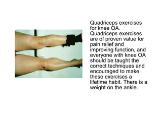 Quadriceps exercises
for knee OA.
Quadriceps exercises
are of proven value for
pain relief and
improving function, and
everyone with knee OA
should be taught the
correct techniques and
encouraged to make
these exercises a
lifetime habit. There is a
weight on the ankle.
 