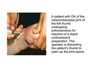 A patient with OA of the
carpometacarpal joint of
the left thumb
undergoing
arthrocentesis for
injection of a depot
corticosteroid
preparation. The
operator is distracting
the patient’s thumb to
open up the joint space.
 