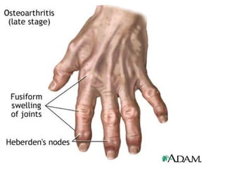 Osteoarthritis ppt