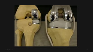 osteoarthritis , bone health, bone weakening | PPTX
