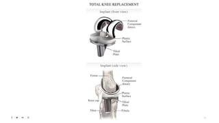 osteoarthritis , bone health, bone weakening | PPTX