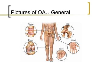 Pictures of OA…General
 