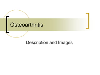Description and Images
Osteoarthritis
 