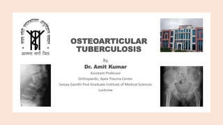 OSTEOARTICULAR
TUBERCULOSIS
By
Dr. Amit Kumar
Assistant Professor
Orthopaedic, Apex Trauma Center
Sanjay Gandhi Post Graduate Institute of Medical Sciences
Lucknow
 