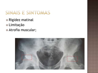  Rigidez matinal
 Limitação
 Atrofia muscular;
 