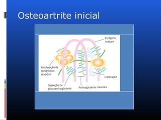 Osteoartrite inicial
 