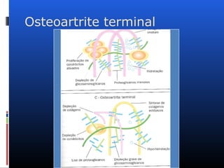Osteoartrite terminal
 