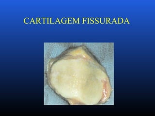 CARTILAGEM FISSURADA
 