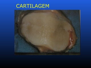 CARTILAGEM
FISSURADA
 